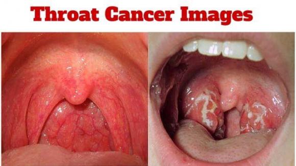 ung thư, ung thư vòm họng, dấu hiệu ung thư vòm họng, triệu chứng ung thư vòm họng