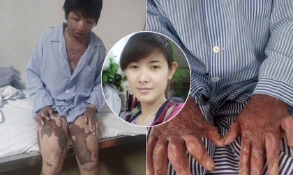 Người phụ nữ bị chồng thiêu sống, Lê Thị Kim Ngân, bị chồng thiêu sống bỏng 92%