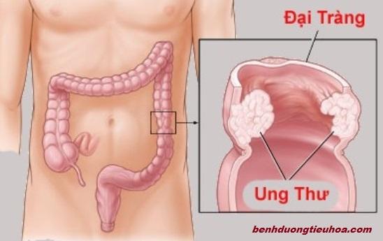đừng coi thường tiêu chảy, dấu hiệu của 6 căn bệnh chết người, căn bệnh chết người