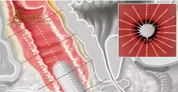 lam-dep-vung-kin-127-3-ngoisao.vn-w580-h301 2 làm đẹp vùng kín, Bí quyết làm đẹp, Làm đẹp sau sinh