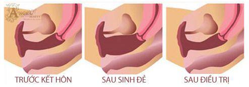 lam-dep-vung-kin-127-5-ngoisao.vn-w494-h173 0 làm đẹp vùng kín, Bí quyết làm đẹp, Làm đẹp sau sinh