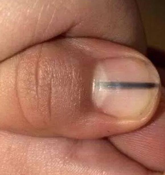 dấu hiệu, sức khỏe, móng tay