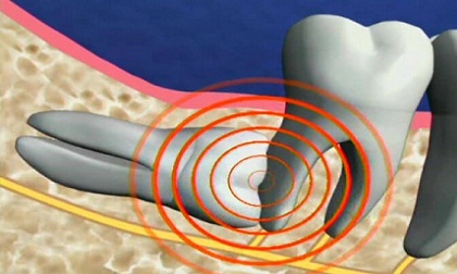 nhổ răng khôn, nhổ răng khôn trước 25 tuổi, lý do nên nhổ răng khôn trước 25 tuổi