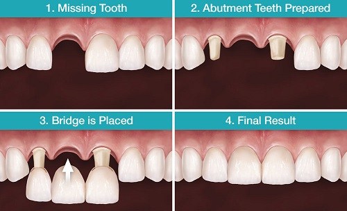 cay-ghep-implant-259-1-ngoisao.vn-w500-h304 4 nha khoa uy tín, Nha khoa Đông Nam, Trồng răng, cấy ghép Implant