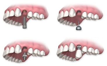 cay-ghep-implant-259-2-ngoisao.vn-w367-h229 3 nha khoa uy tín, Nha khoa Đông Nam, Trồng răng, cấy ghép Implant