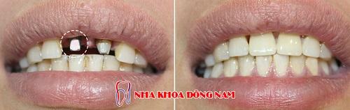 cay-ghep-implant-259-3-ngoisao.vn-w500-h158 2 nha khoa uy tín, Nha khoa Đông Nam, Trồng răng, cấy ghép Implant