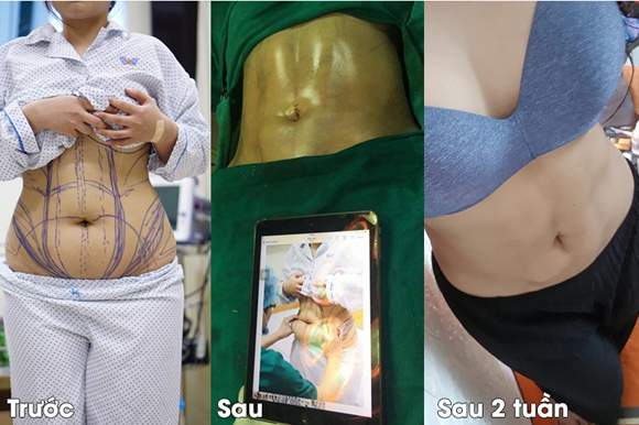 body-jet-finnes-2410-2-ngoisao.vn-w580-h386 1 Body Jet Fitness, hút mỡ, hút mỡ Body Jet Fitness