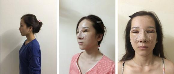 phẫu thuật thẩm mỹ, lột xác nhờ dao kéo, nữ sinh đại học vinh dao kéo, Lương Thị Hà