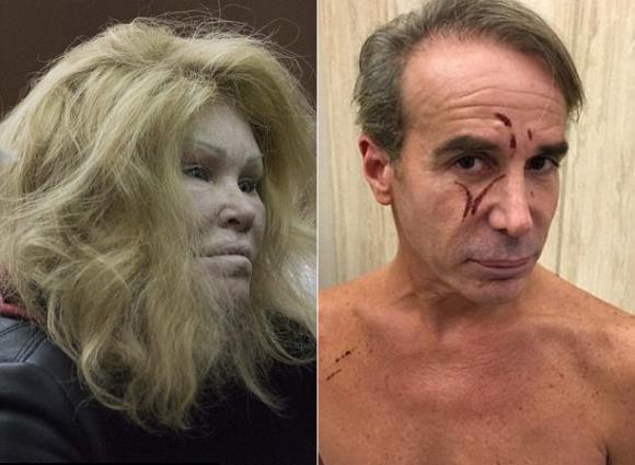 thảm họa dao kéo Mỹ,Jocelyn Wildenstein,Lloyd Klein