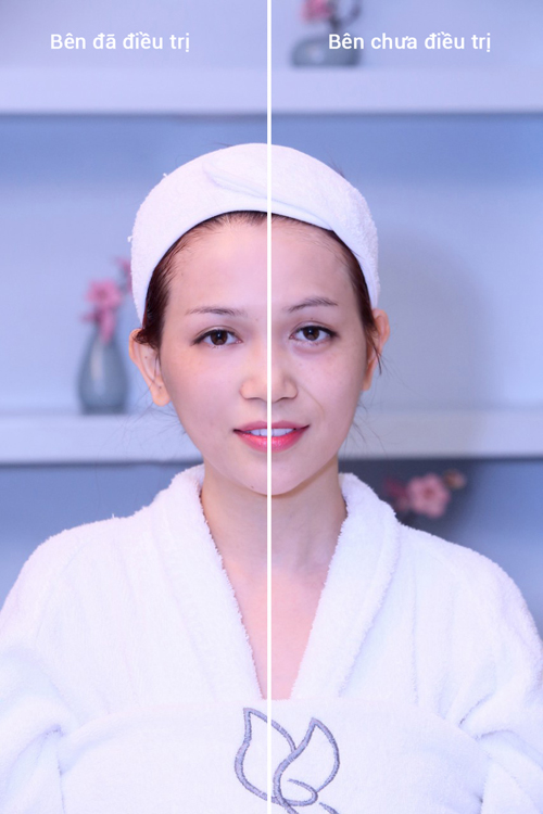 Sỹ Thanh, BB Thanh Mai, Trẻ hóa da