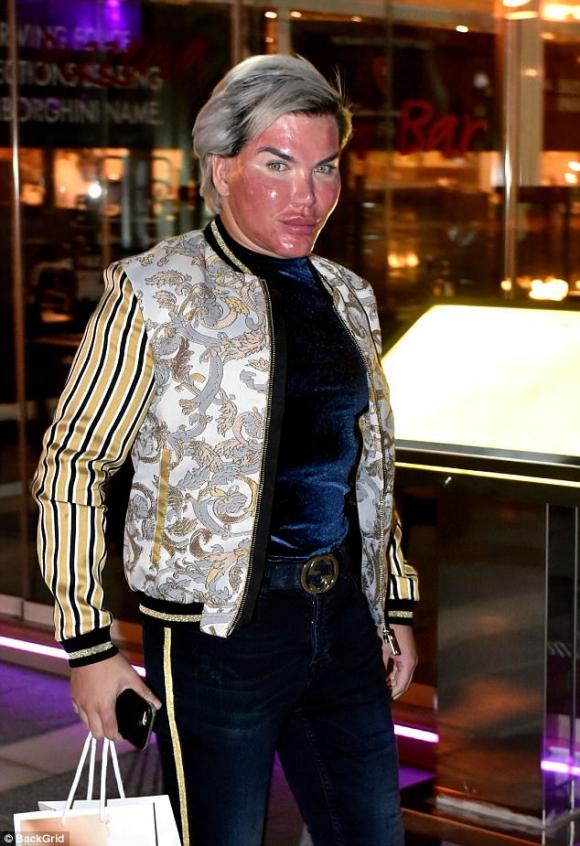  tiêm filler, Rodrigo Alves, búp bê Ken