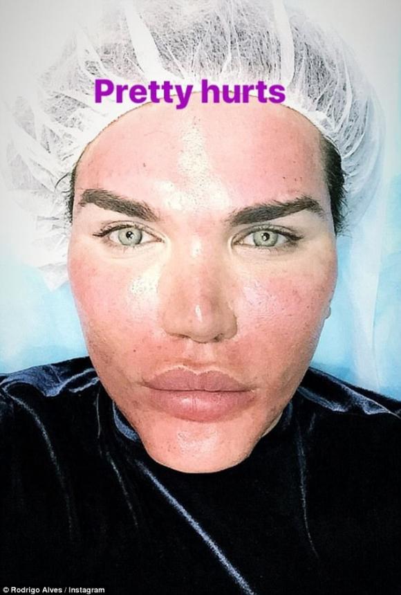  tiêm filler, Rodrigo Alves, búp bê Ken