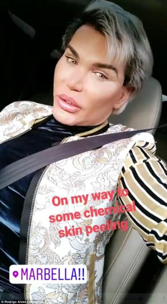  tiêm filler, Rodrigo Alves, búp bê Ken