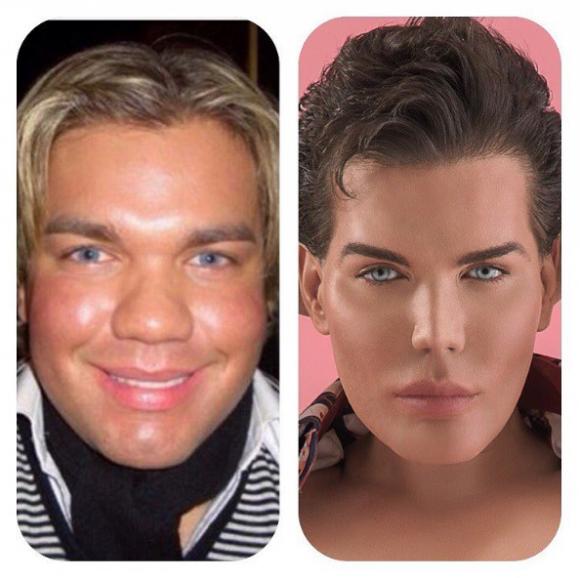  tiêm filler, Rodrigo Alves, búp bê Ken