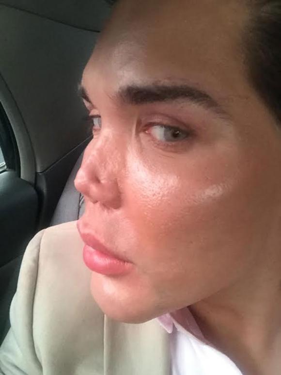  tiêm filler, Rodrigo Alves, búp bê Ken