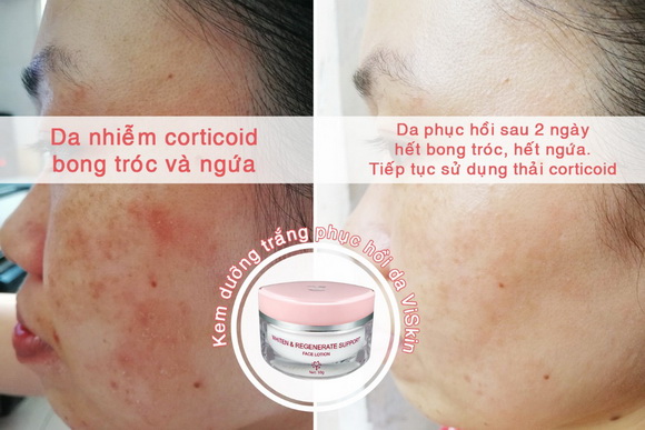 kem-viskin-191-1-ngoisao.vn-w580-h387 4 mỹ phẩm ViSkin, Kem dưỡng phục hồi da Viskin