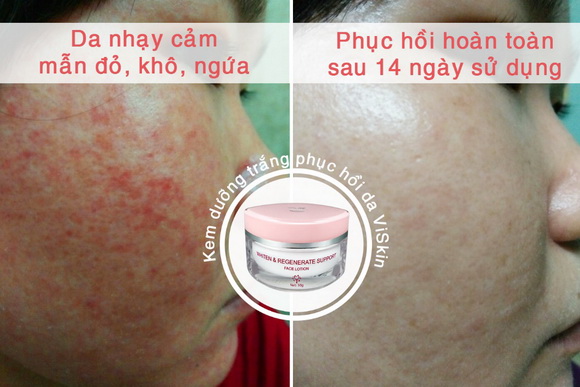 kem-viskin-191-5-ngoisao.vn-w580-h387 0 mỹ phẩm ViSkin, Kem dưỡng phục hồi da Viskin