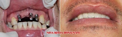 nha-khoa-dong-nam-241-1-ngoisao.vn-w500-h151 6 cấy ghép răng ETK Active, Nha Khoa Đông Nam, cấy ghép răng Implant