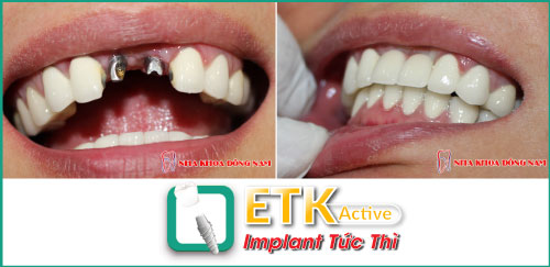 nha-khoa-dong-nam-241-5-ngoisao.vn-w500-h243 2 cấy ghép răng ETK Active, Nha Khoa Đông Nam, cấy ghép răng Implant