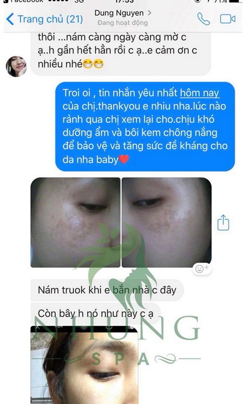 nhung-spa-13-8-ngoisao.vn-w500-h830 1 Nhung Spa, trị nám, trị nám hiệu quả