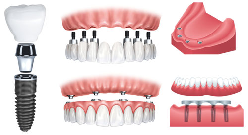 cay-ghep-iplant-144-1-ngoisao.vn-w500-h274 4 Nha khoa đông nam, cấy ghép Implant, trồng răng Implant