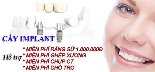 cay-ghep-iplant-144-2-ngoisao.vn-w500-h234 3 Nha khoa đông nam, cấy ghép Implant, trồng răng Implant