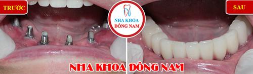 cay-ghep-iplant-144-4-ngoisao.vn-w500-h146 1 Nha khoa đông nam, cấy ghép Implant, trồng răng Implant