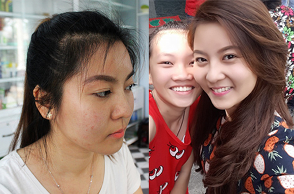 Viên uống trắng da Ladorax, Điều trị nám da, nám da