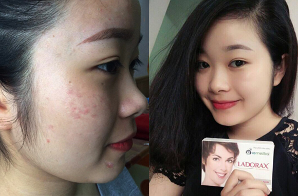 Viên uống trắng da Ladorax, Điều trị nám da, nám da