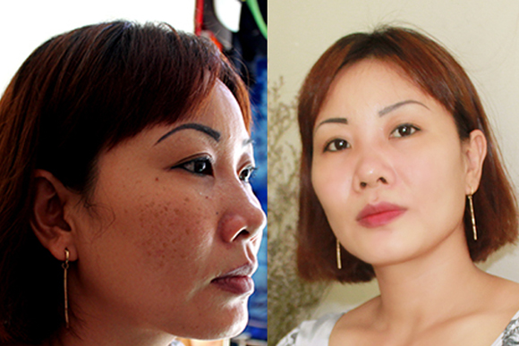 Viên uống trắng da Ladorax, Điều trị nám da, nám da