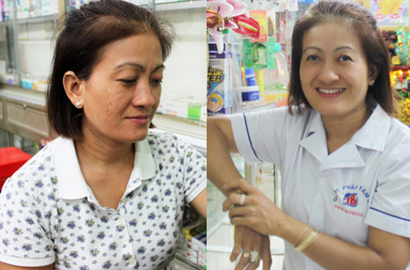 Viên uống trắng da Ladorax, Điều trị nám da, nám da