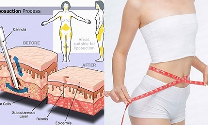 6 bài tập giúp là phẳng vùng da bị rạn ở mông, cách giảm cân hiệu quả, những bài tập giúp điều chỉnh vùng da bị rạn ở mông