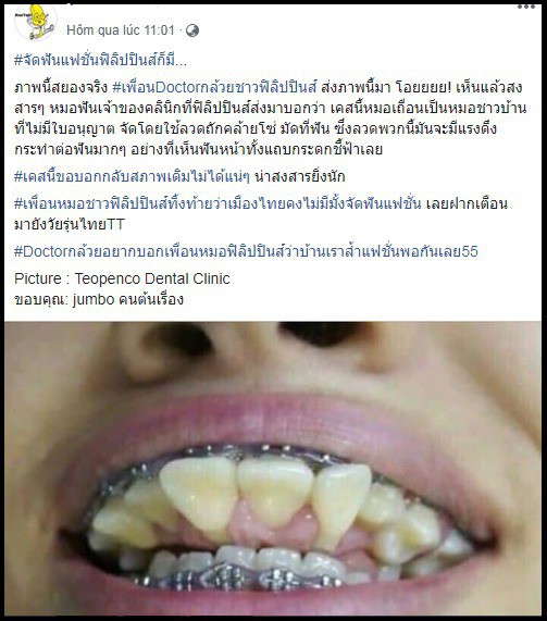 niềng răng, tai nạn niềng răng, tai nạn niềng răng đáng sợ trên thế giới 