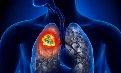 ung thư phổi, ung thư, dấu hiệu của ung thư phổi