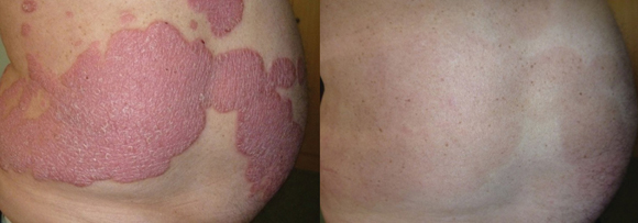 benh-vay-nen-288-2-ngoisao.vn-w580-h203 0 điều trị bệnh vảy nến, phòng khám chuyên khoa Dr. Michaels Psoriasis & Skin Clinic
