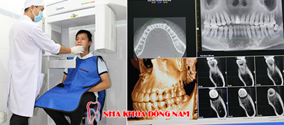 trồng răng Implant, Nha Khoa Đông Nam, Phòng khám răng uy tín