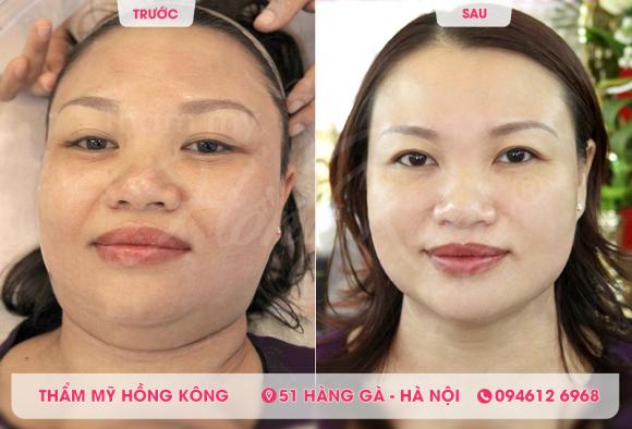 Trẻ hóa da, Thẩm mỹ Hồng Kông, trẻ hóa da bằng công nghệ cao