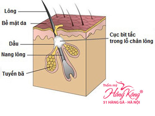 Mụn trứng cá mọc nhiều ở ngực, điều trị mụn trứng cá, Thẩm mỹ Hồng Kông
