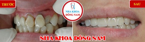 Dán răng sứ, Nha Khoa Đông Nam, Bọc răng thẩm mỹ