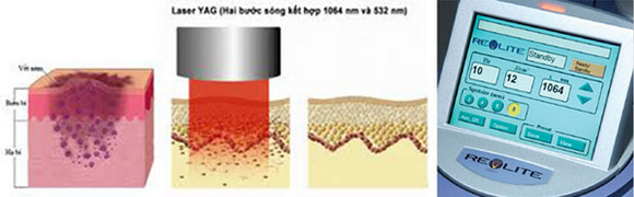 Trị nám hiệu quả, Trị nám công nghệ cao, BB Thanh Mai
