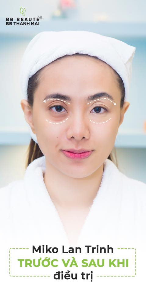 BB Thanh Mai,MC Thanh Mai,trẻ hóa da