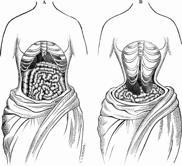 đai nịt bụng, gen nịt bụng, gen bịt bụng giảm mỡ, đeo đai nịt bụng giảm mỡ, tác dụng phụ của gen nịt bụng