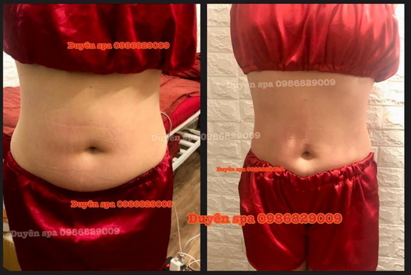 duyen-spa-1812-9-ngoisao.vn-w580-h388 2 Duyên Spa, điều trị mụn, giảm mỡ bụng, địa chỉ làm đẹp uy tín tại hà nội