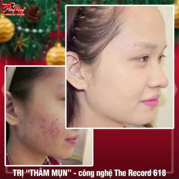 tri-tham-mun-2112-ngoisao.vn-w600-h600 0 Trị thâm mụn, Thẩm mỹ Hồng Kông, trị mụn công nghệ cao
