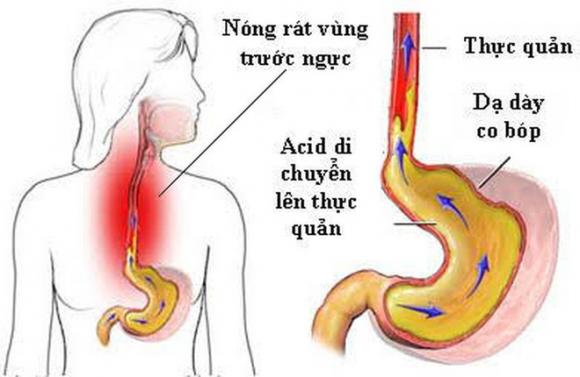 Trào ngược dạ dày, ung thư, bệnh dạ dày