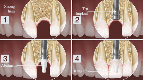 nha-khoa-dong-nam-183-1-ngoisao.vn-w500-h281 7 Nha Khoa Đông Nam, Trồng răng sứ, Cấy ghép Implant