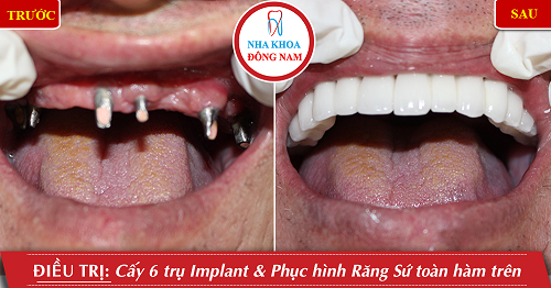 nha-khoa-dong-nam-183-2-ngoisao.vn-w500-h262 6 Nha Khoa Đông Nam, Trồng răng sứ, Cấy ghép Implant
