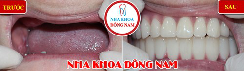 nha-khoa-dong-nam-183-4-ngoisao.vn-w500-h146 4 Nha Khoa Đông Nam, Trồng răng sứ, Cấy ghép Implant