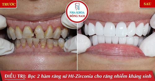 nha-khoa-dong-nam-183-6-ngoisao.vn-w500-h262 2 Nha Khoa Đông Nam, Trồng răng sứ, Cấy ghép Implant
