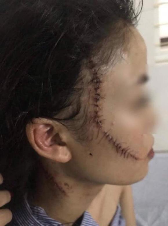 Thiếu nữ 18 tuổi bị rạch mặt, rạch mặt thiếu nữ ở Bắc Ninh, Tin pháp luật